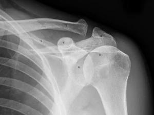 دررفتگی مفصل آکرومیوکلاویکولار