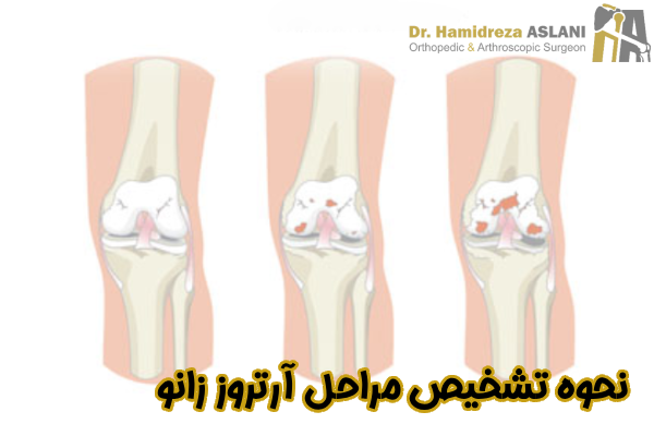 نحوه تشخیص مراحل آرتروز زانو