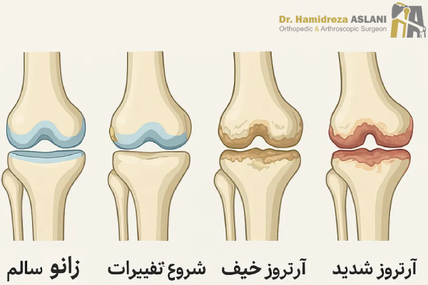 مراحل آرتروز زانو