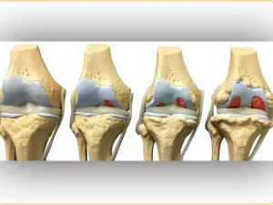 مراحل پیشرفت آرتروز زانو