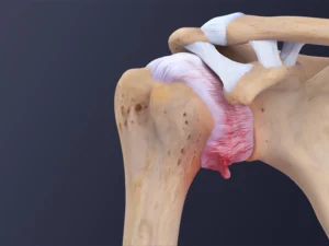 شانه یخ زده و دیابت