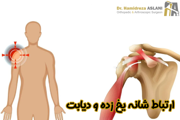 ارتباط شانه یخ زده و دیابت
