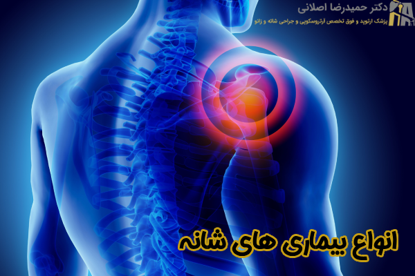 انواع بیماری های شانه