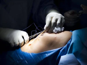 جراحی ترمیم مینیسک زانو