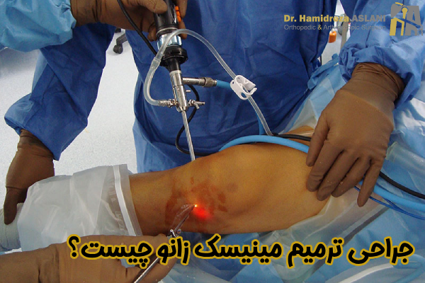 جراحی ترمیم مینیسک زانو چیست
