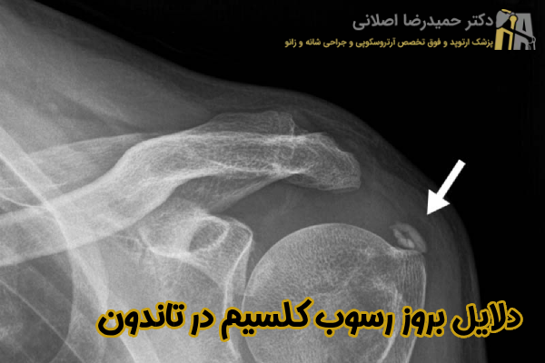 دلایل بروز رسوب کلسیم در تاندون