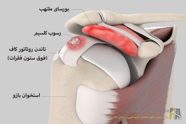علائم رسوب کلسیم در تاندون