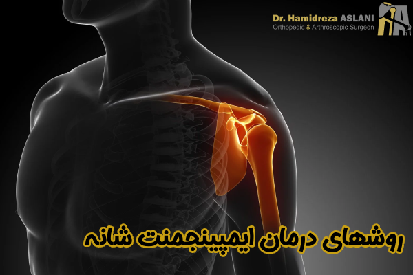 روشهای درمان ایمپینجمنت شانه