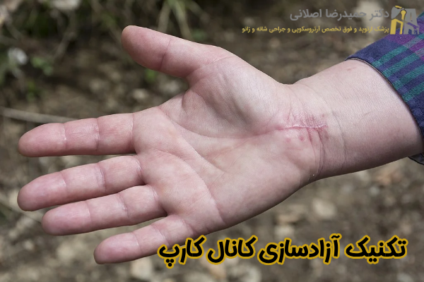 تکنیک آزادسازی کانال کارپ
