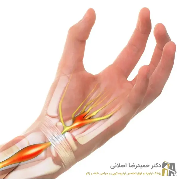 عوارض تنگی کانال مچ دست