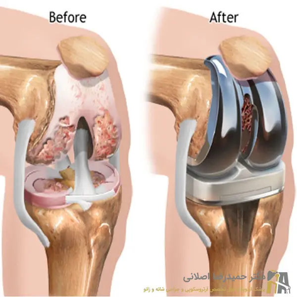 انواع جراحی تعویض مفصل زانو