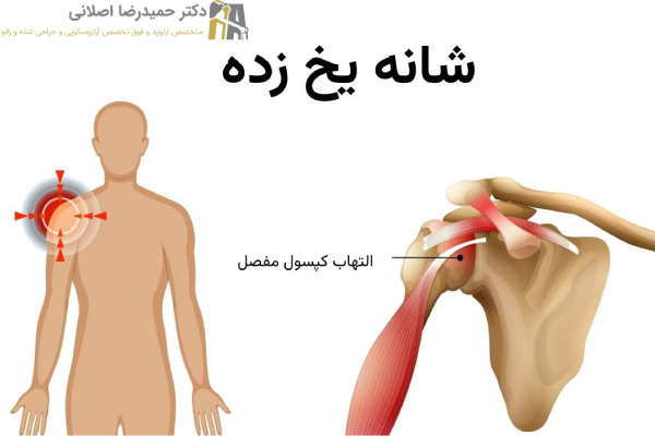 مراحل شانه یخ زده