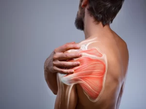 آرتریت شانه