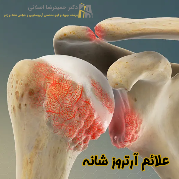علائم آرتروز شانه