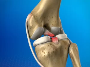 پارگی رباط صلیبی زانو