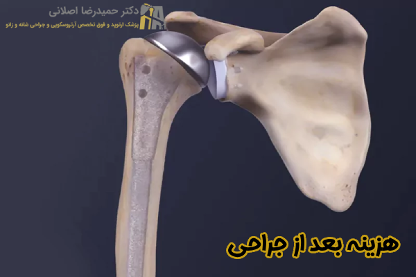 هزینه بعد از جراحی تعویض مفصل شانه