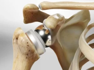 هزینه جراحی تعویض مفصل شانه