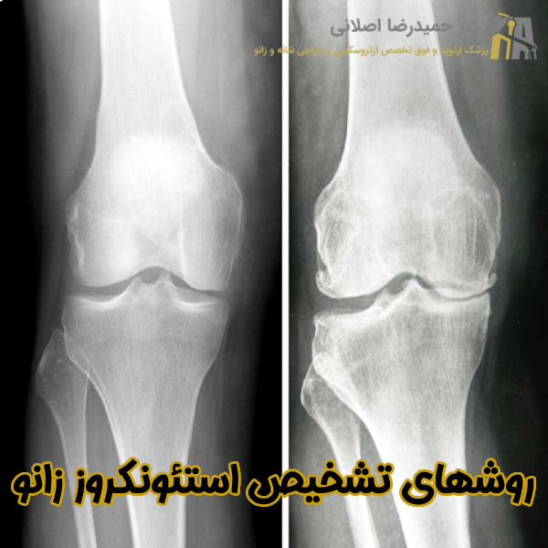 تشخیص استئونکروز زانو