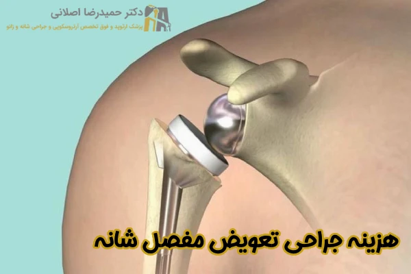 هزینه عمل تعویض مفصل شانه