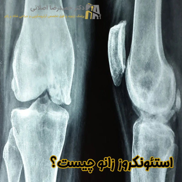 استئونکروز زانو چیست
