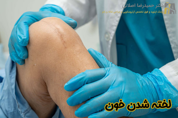 لخته شدن خون بعد از آرتروسکوپی زانو