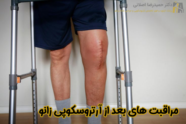 مراقبت بعد از جراحی آرتروسکوپی زانو