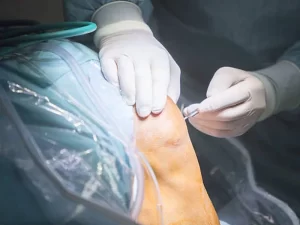 عوارض آرتروسکوپی زانو