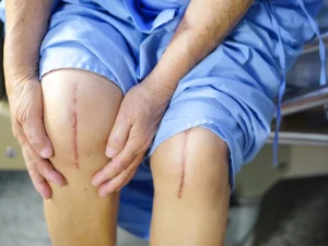 عوارض جراحی تعویض مفصل زانو