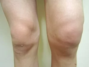 بورسیت زانو