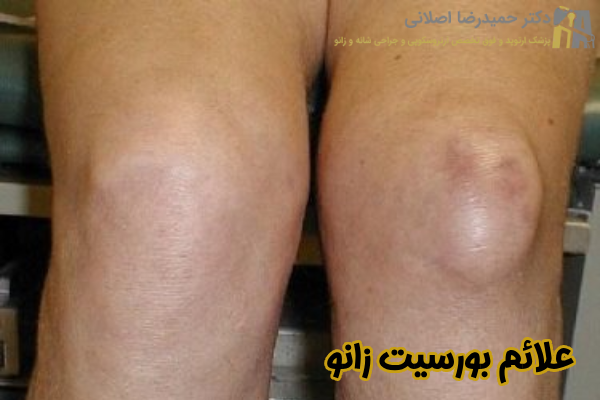 علائم بورسیت زانو