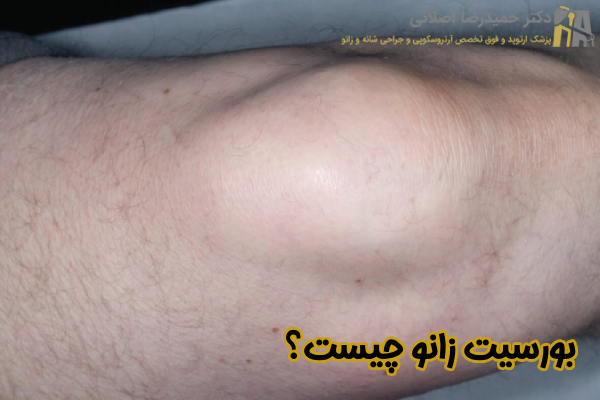 بورسیت زانو چیست