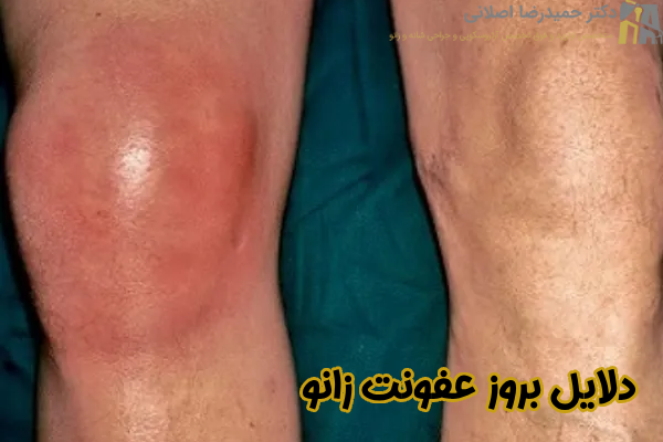 دلایل بروز عفونت زانو