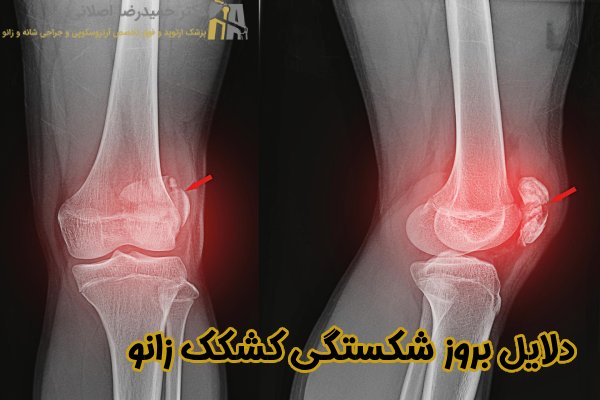 دلایل بروز شکستگی کشکک زانو
