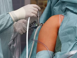 هزینه آرتروسکوپی شانه