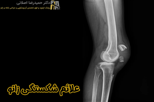 علائم شکستگی زانو