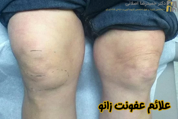 علائم عفونت زانو