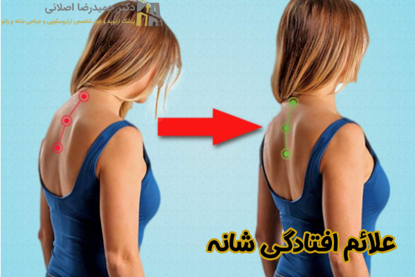 علائم افتادگی شانه