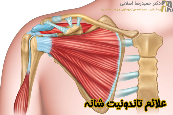 علائم تاندونیت شانه