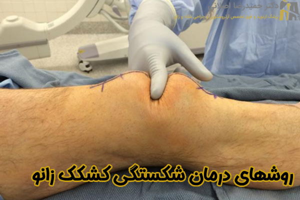 روشهای درمان شکستگی کشکک زانو