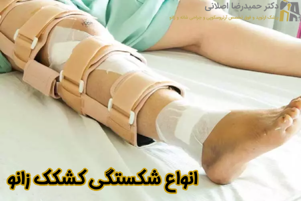 انواع شکستگی کشکک زانو