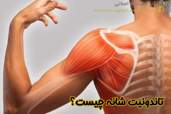 تاندونیت شانه چیست