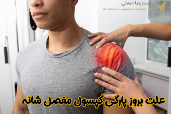 علت بروز پارگی کپسول مفصل شانه