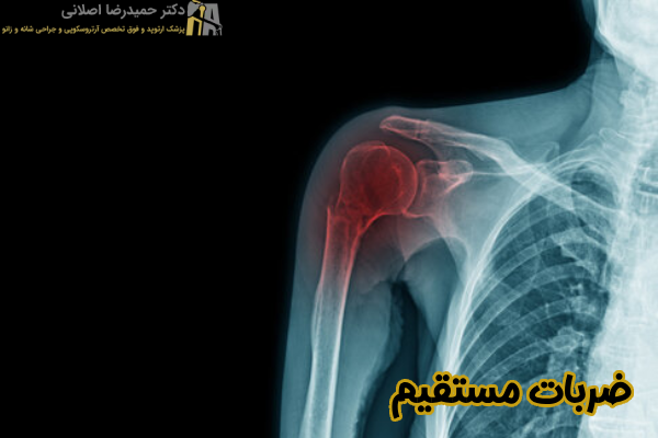 ضربات مستقیم
