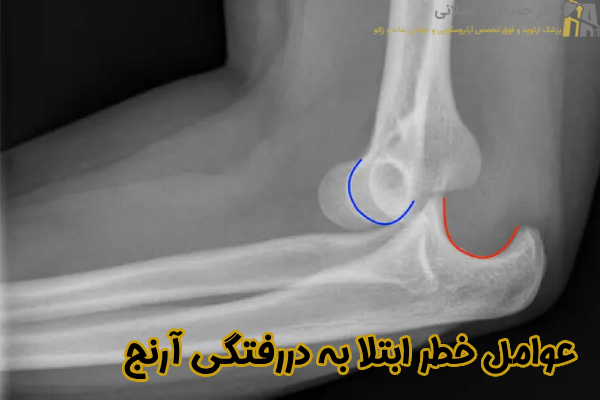 عوامل خطر ابتلا به دررفتگی آرنج