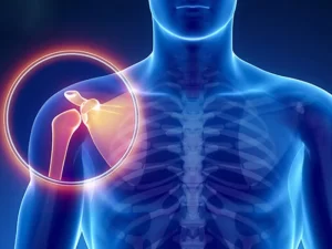 شکستگی شانه