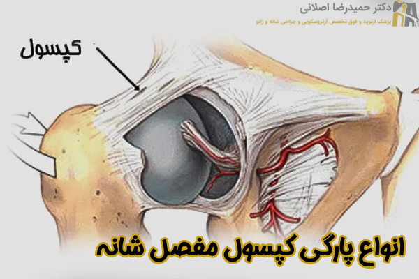 انواع پارگی کپسول مفصل شانه