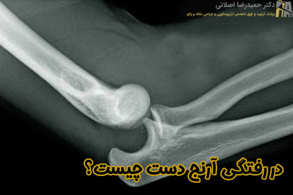 در رفتگی آرنج چیست