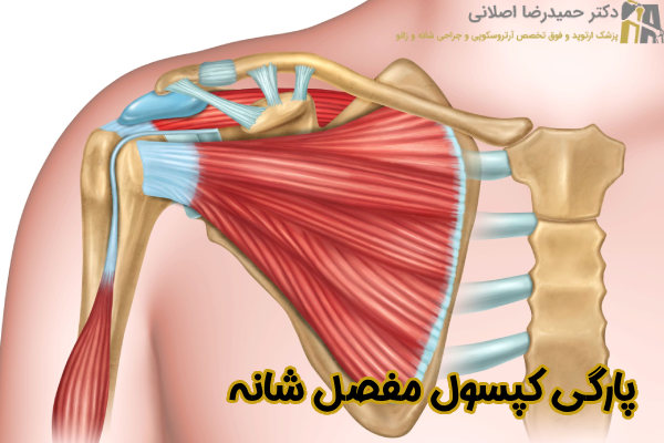 پارگی کپسول مفصل شانه چیست