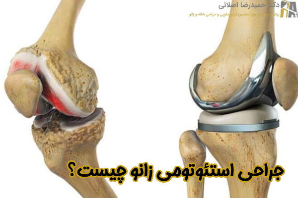 جراحی استئوتومی زانو چیست