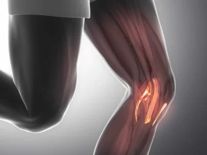 تاندونیت زانو